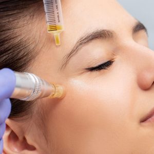 16microneedling