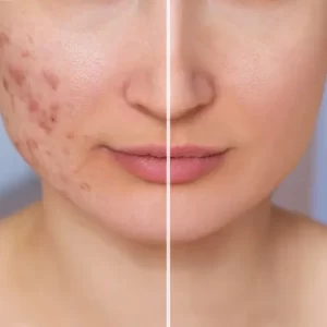 8acne